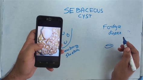 Sebaceous Cyst Youtube