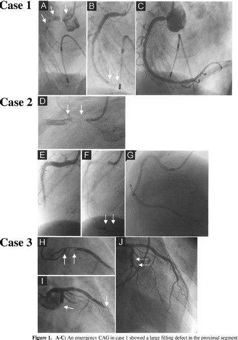 Figure 1 From Three Cases Of Acute Myocardial Infarction Due To