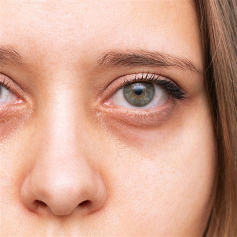 Causes Of Hyperpigmentation Under The Eyes Skin Technique