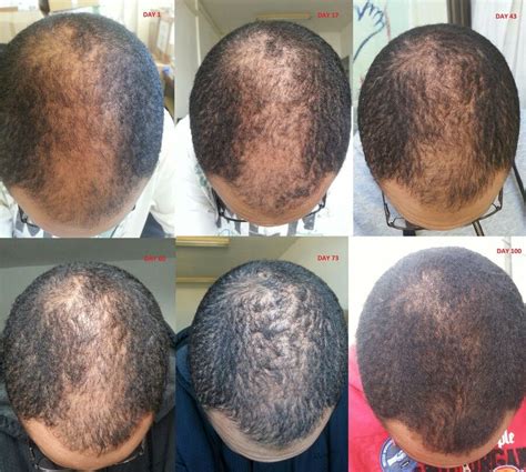Minoxidil Before And After Results
