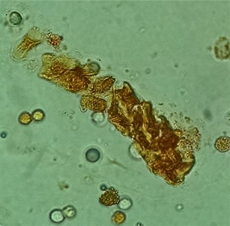 Urine Sediment of the Month: Pigmented Casts & What Those Pretty Colors ...