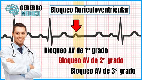 Bloqueos Auriculo Ventricualres Bloqueos Av De 1° 2° Y 3° Como