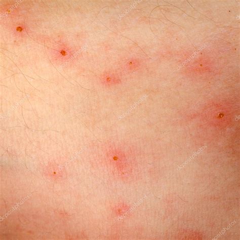 Erupción Alérgica Dermatitis Eccema Piel 2022