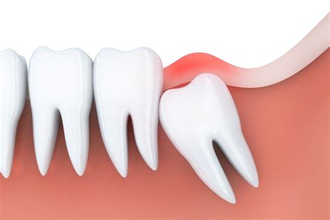 Treating Dry Socket After Wisdom Teeth Extraction In Waco