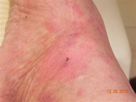 Dr Scholls Insert Machine Reviews Lupus Sore Foot Anti Odor Foot