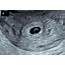 5 Weeks With Emelia First OB Ultrasound  Risa Kerslake