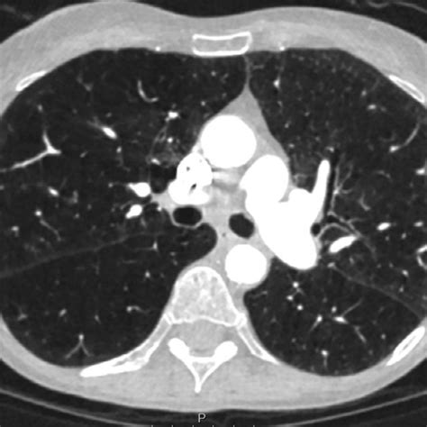Axial Chest Ct With Iv Contrast Upon Referral Axial Chest Ct With Iv