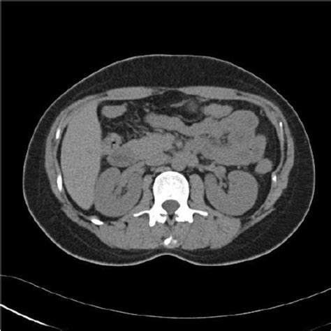 Computed Tomography Noncontrast Ct Of The Abdomen Was Negative For