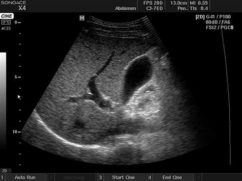 Ultrasound Images • Liver And Gallbladder B Mode Echogramm №401