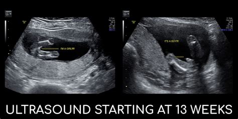 21 Weeks Pregnant Ultrasound Gender