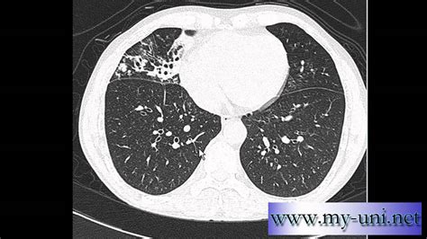 Ct Chest How To Differentiate Between Pulmonary Arteries