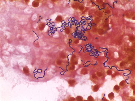 Gram Stain Of Brain Tissue From Case 3 Showing Gram Positive Cocci In