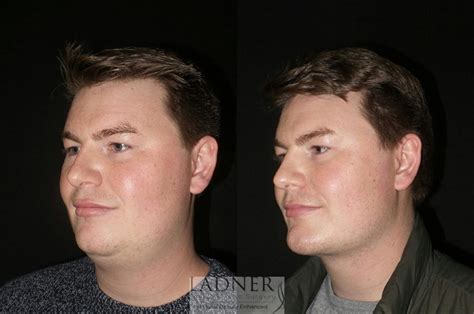 Chin Augmentation Buccal Fat Removal Before And After Pictures Case