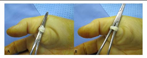 Figure 1 From Incidence Of Flexor Tendon Fraying Found During A1 Pulley