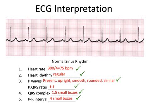 How To Read An ECG ECG Interpretation EKG Geeky Medics Vlr Eng Br