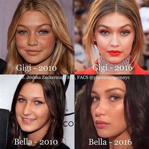 Bella hadid | before and after transformations (plastic surgery rumors, make up, fitness & more)bella hadid and her sister gigi hadid have been in the. Both Gigi and Bella Hadid before and after plastic surgery | What a fake world!!!! | Pinterest ...