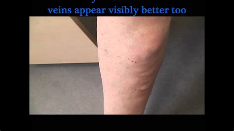 Severe Superficial Thrombophlebitis Before And 48 Hours After Treatment