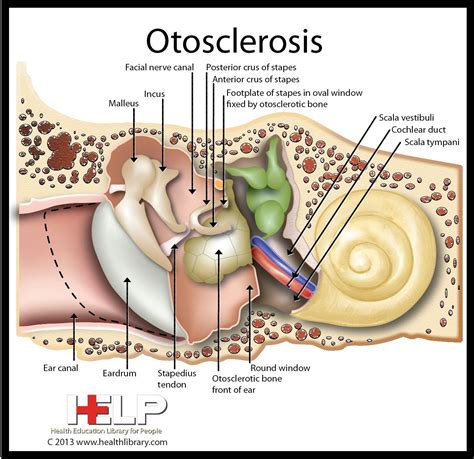 Otosclerosis Tinnitus Symptoms Audiology Ear Anatomy