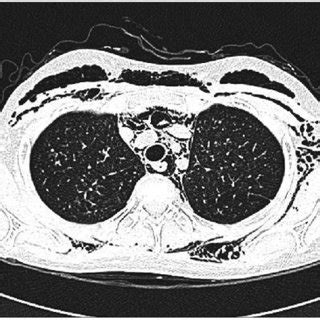 High Resolution CT Of The Chest Showing The Subcutaneous Emphysema And