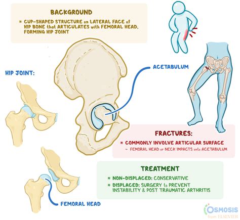 Acetabulum What Is It Function Fractures And More Osmosis