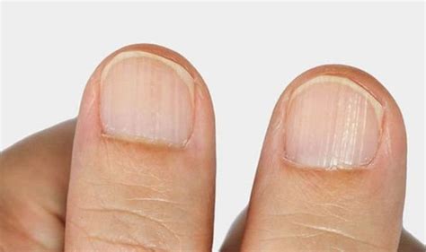 The 5 Signs In Your Nails You Have A Vitamin Deficiency From White