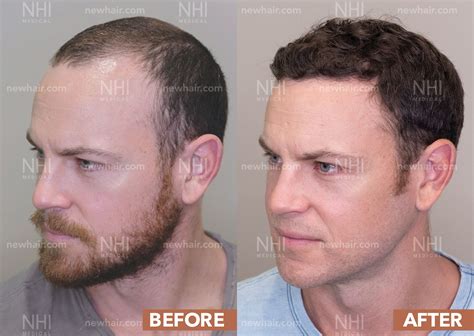 Before And After Gallery Transformations Of Nhi Medical Patients