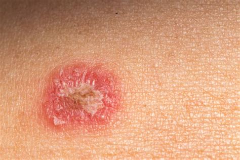 Cellulitis Stock Photos Pictures And Royalty Free Images Istock