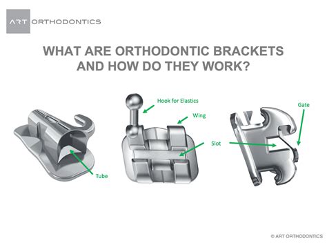 Orthodontic Brackets Braces How Do They Work Art Orthodontics