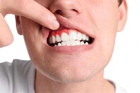 Gum Boils Symptoms Causes Home Remedies And Treatments