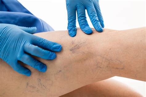 Understanding Restless Leg Syndrome Las Vegas Vein And Skin Clinic Varicose Veins Spider