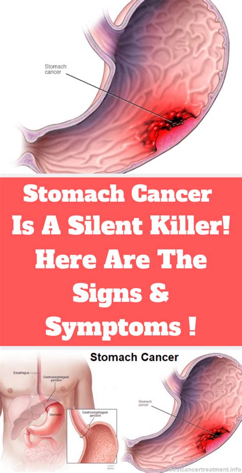 With time, cells can break off and spread (metastasize) to other areas of. Signs And Symptoms of Stomach Cancer ! - Ideas To Try