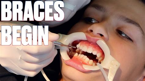 Getting Braces For The First Time How To Shorten Time With Braces By Six Months Youtube