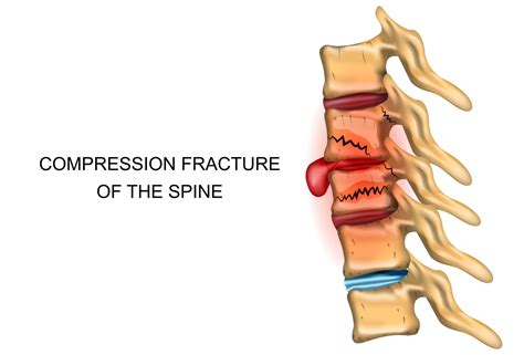 How To Prevent Compression Fractures Fort Worth Neurosurgeon Dr