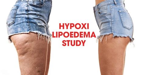 Hypoxi Helps Relieve Symptoms Of Lipoedema Hypoxi Usa