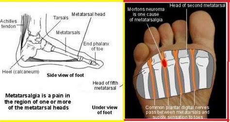 Metatarsalgia Or Foot Pain The Orthobiologic Clinic