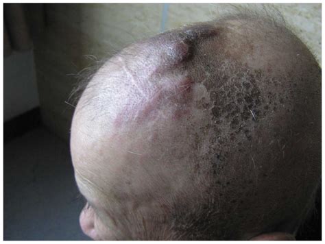 Long‑term Survival Of A Patient With Scalp Angiosarcoma And Multiple
