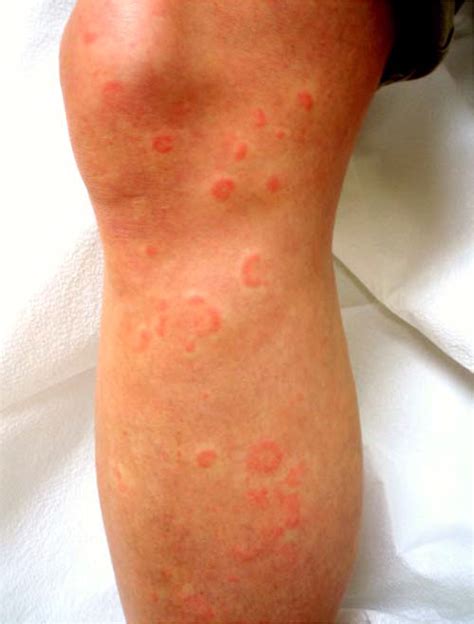 Erythema Multiforme Recognition And Management Aafp