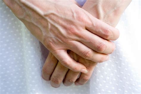 Bulging Hand Veins Causes And Treatments Med