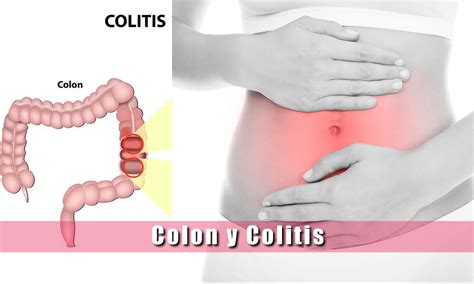 Colon Y Colitis Causas Síntomas Tratamiento Diagnostico Colonoscopias