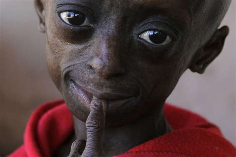Child 12 With Progeria Fights Aging Disease