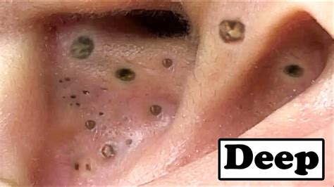Best Removal Of Deep Big Blackheads In The Ear Youtube