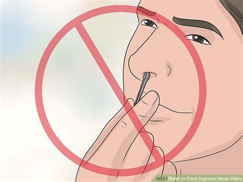 How To Treat Ingrown Nose Hairs 11 Steps With Pictures