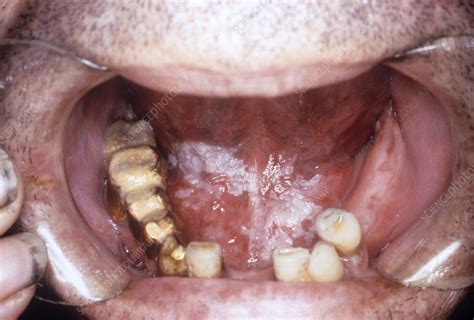 Leukoplakia Of The Mouth Stock Image C0235754 Science Photo Library