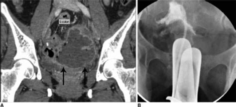 Transvaginal Approach For Pelvic Abscess Drainagea 9 Open I