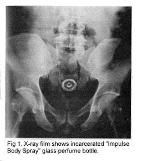 Butt X Rays Pick Your Favorite And How It Got There Album On Imgur