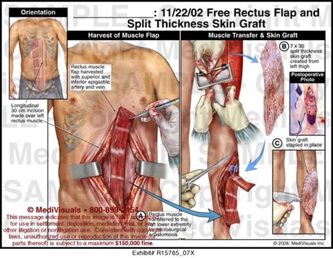 Free Rectus Flap And Split Thickness Skin Graft Medical Exhibit