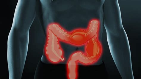 We did not find results for: Detectar y tratar a tiempo la enfermedad de Crohn es ...