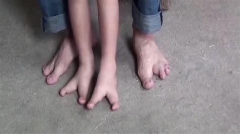dad s moving wish for five year old son who was born with just two toes on each foot world