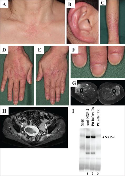 Jle European Journal Of Dermatology A Case Of Anti Nxp2 Antibody