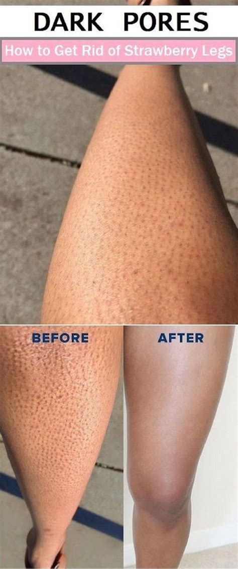 Dark Pores On The Legs Are One Of The Weird Things For Women While